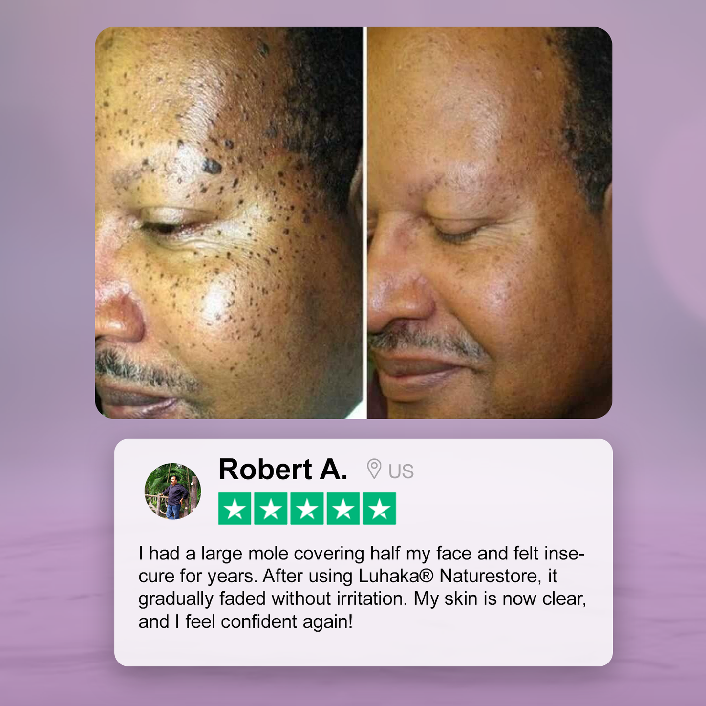 Luhaka® Naturestore Wart and Mole Removal Gel 🌟