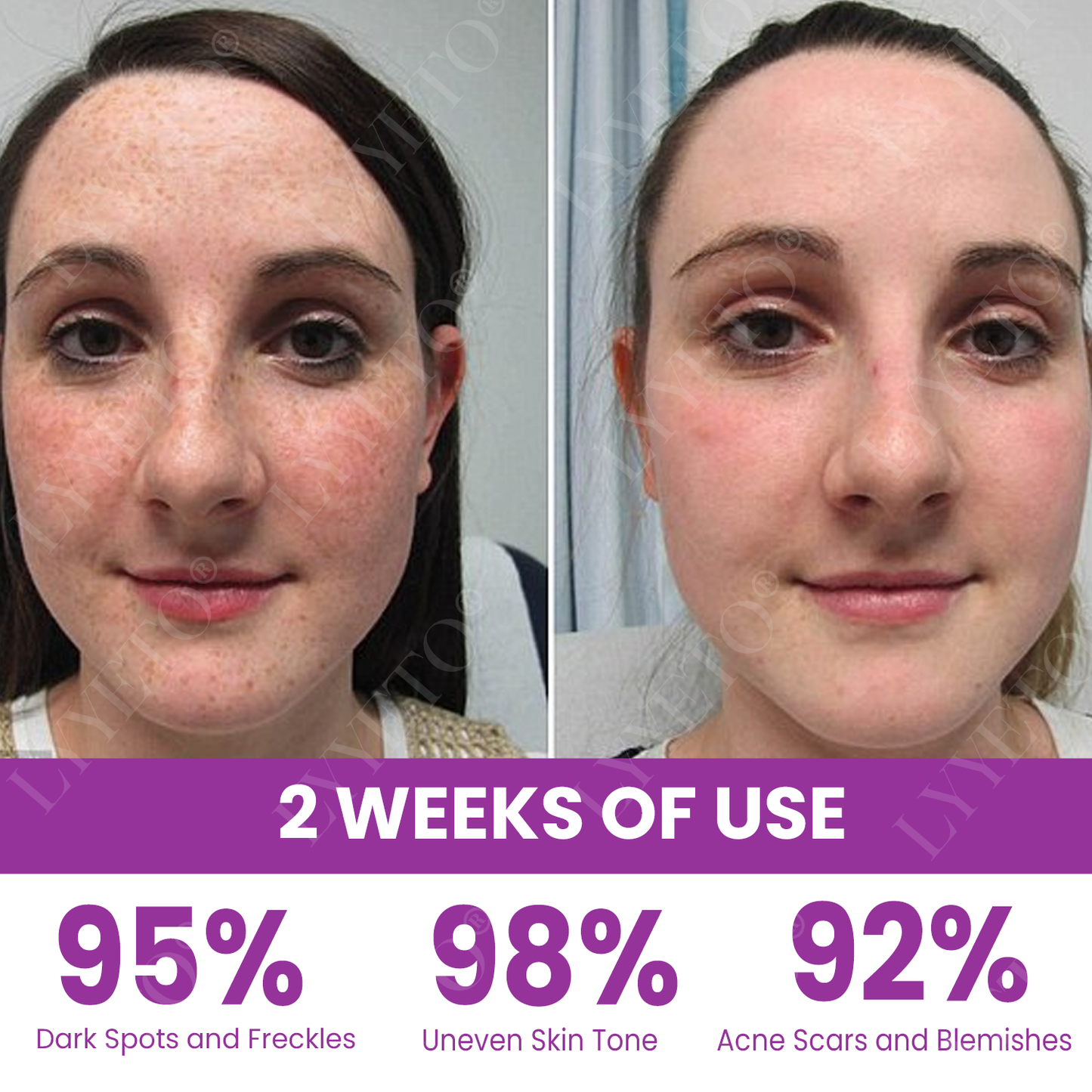 Lyyeto® MelantraX Advanced Brightening Essence 🏆