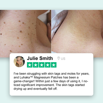 Luhaka® Magnesium Micro-pin Wart Removal Patch 🏆Limited Sales