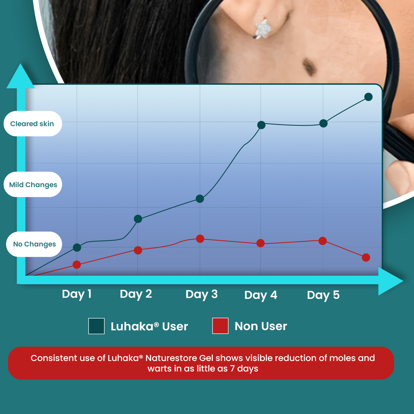 Luhaka® Naturestore Mole and Wart Removal Gel_Ultra02