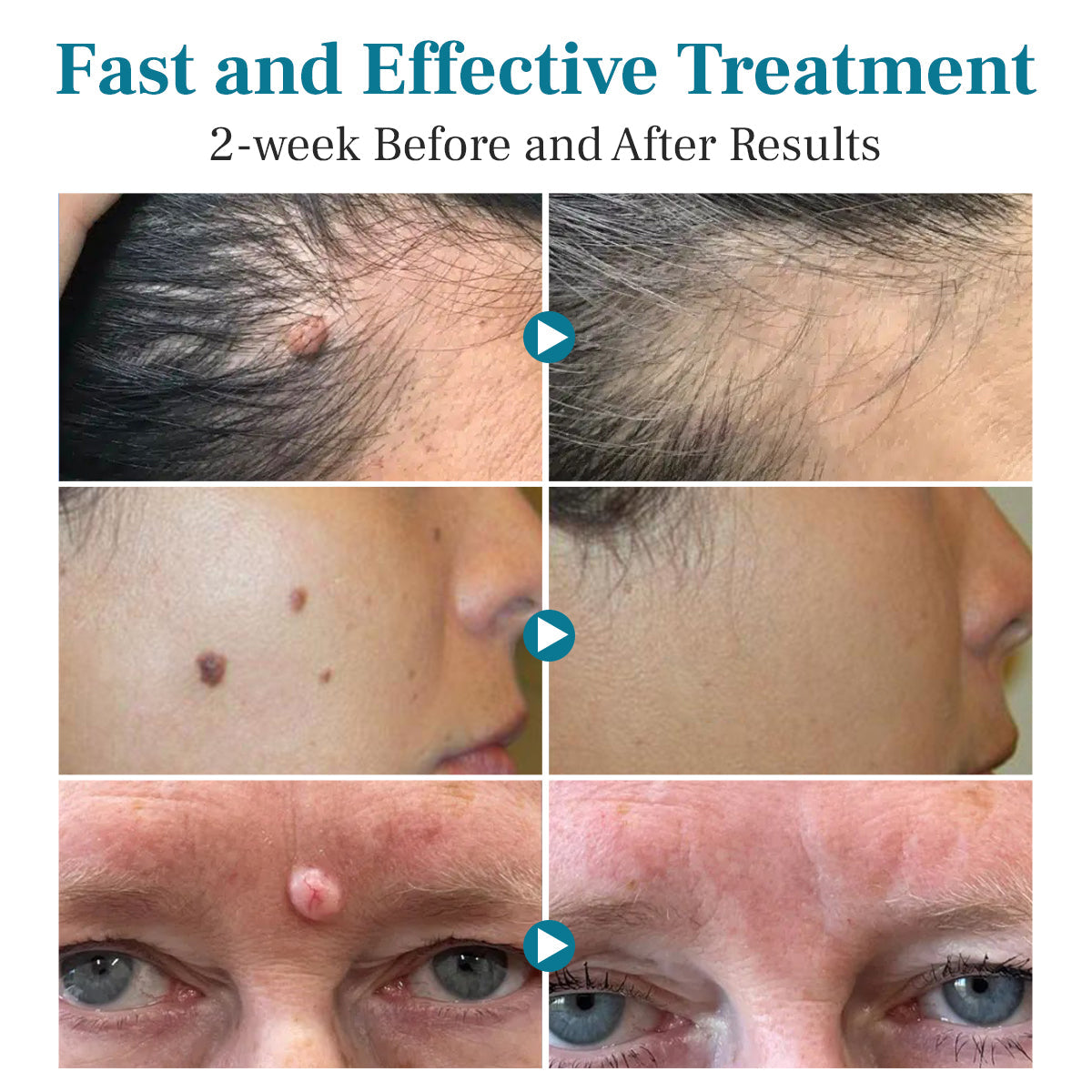 DAFEILA® LumeSkin Mole and Wart Removal Laser Pen