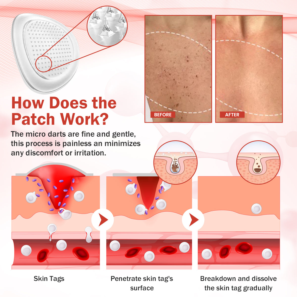 Luhaka® PureSkin Microneedle Botanic Skin Tag Removal Patch ACE 2