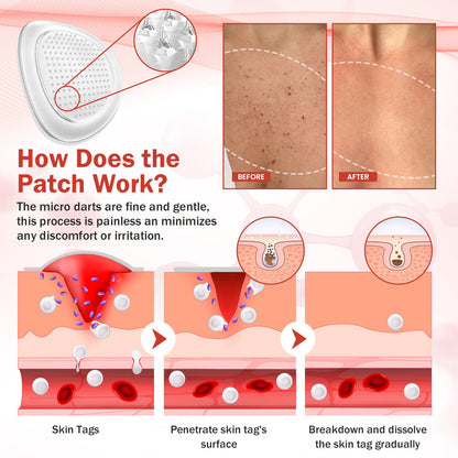 Luhaka® PureSkin Microneedle Botanic Skin Tag Removal Patch ACE 2