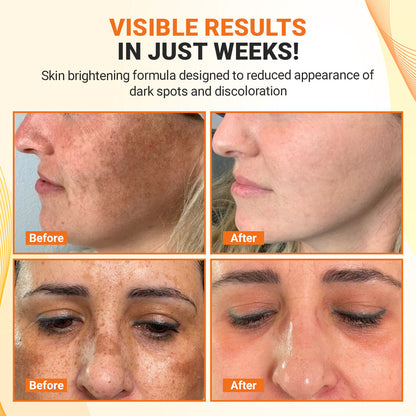 Luhaka® TripleAction Vitamin C Freckle Removal Cream ACE