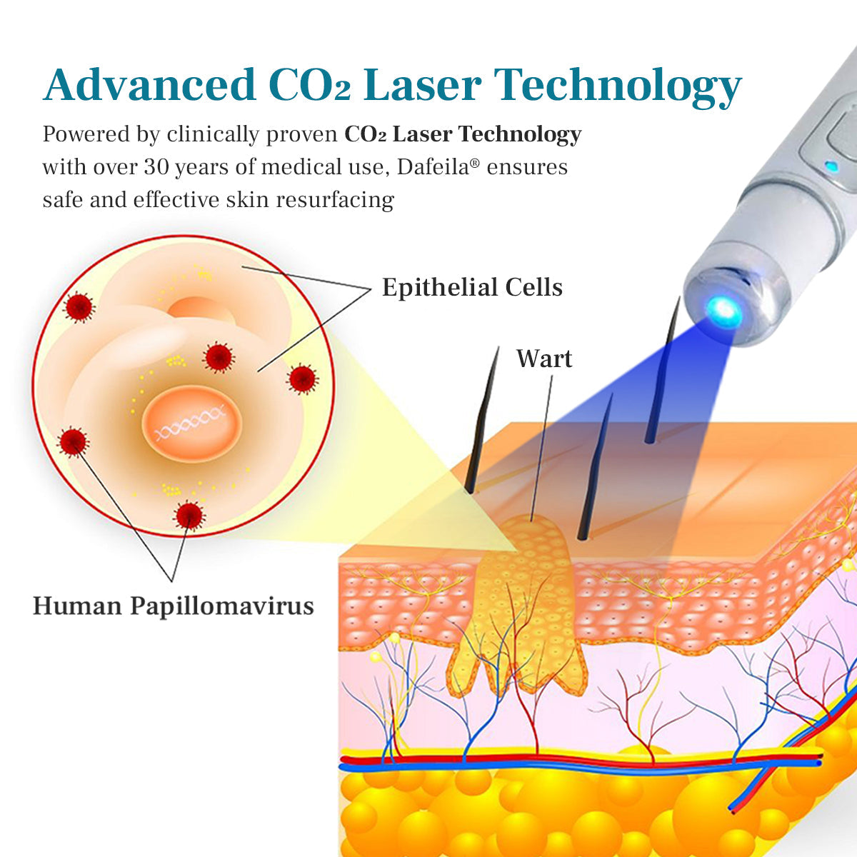 DAFEILA® LumeSkin Mole and Wart Removal Laser Pen 3