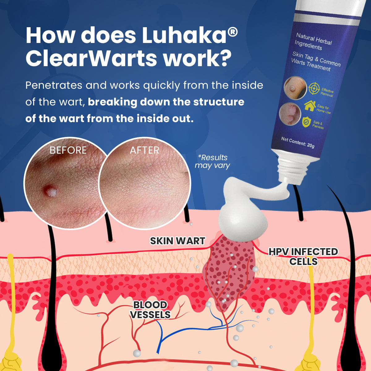 Luhaka® ClearWarts  Instant Blemish Removal Cream
