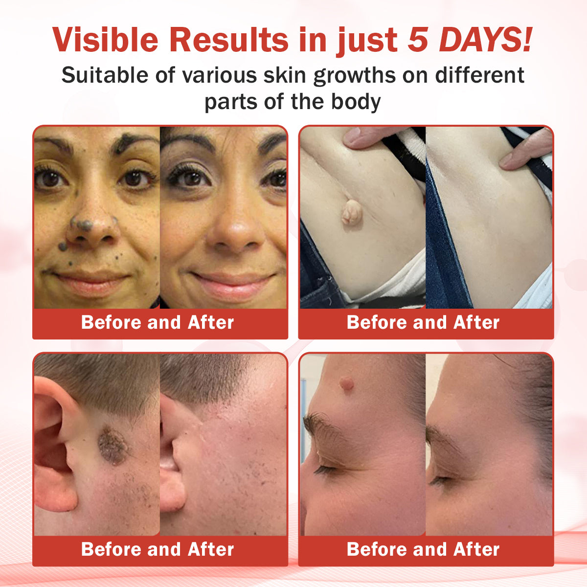 Luhaka® PureSkin Microneedle Botanic Skin Tag Removal Patch ACE 2