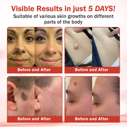 Luhaka® PureSkin Microneedle Botanic Skin Tag Removal Patch ACE 2