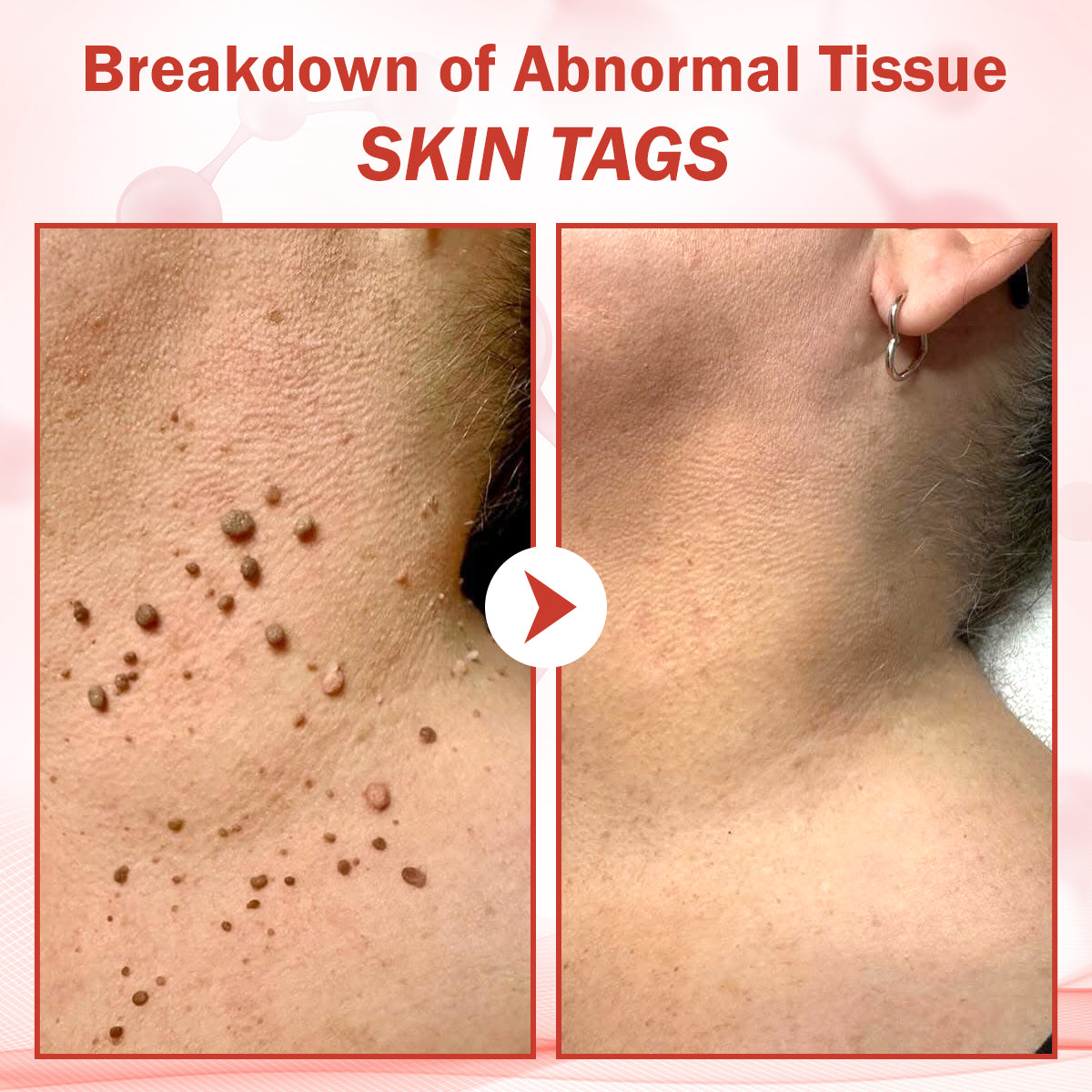 Luhaka® PureSkin Microneedle Botanic Skin Tag Removal Patch ACE 2