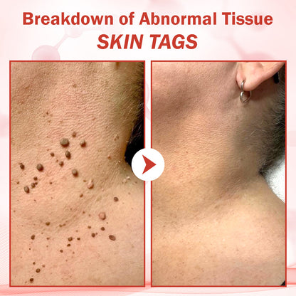 Luhaka® PureSkin Microneedle Botanic Skin Tag Removal Patch ACE 2