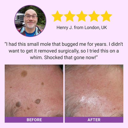 Luhaka® DermaClear Mole and Dark Spot Removal Bio-Gel_Ultra01