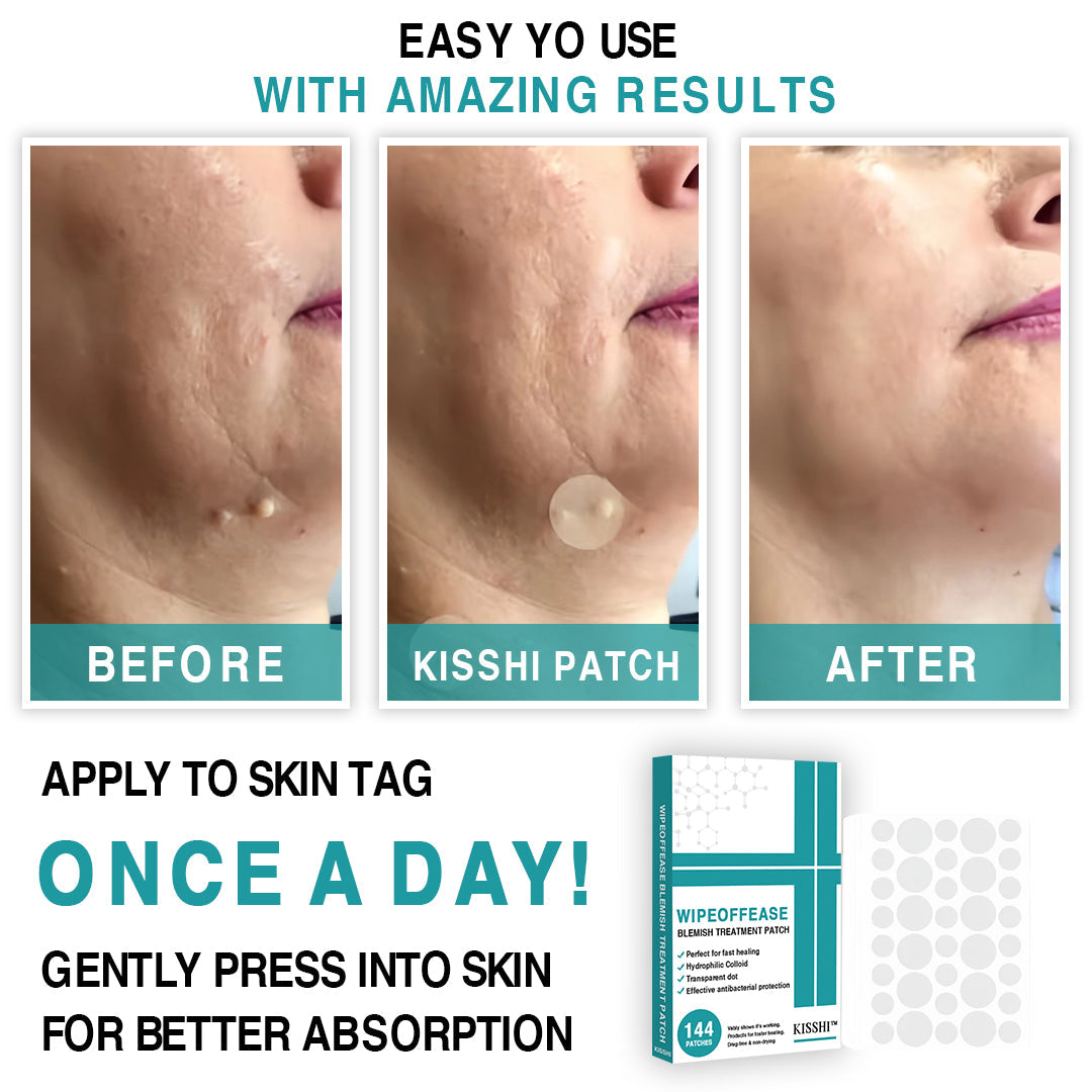KISSHI™ WipeOffEase Blemish Treatment Patch